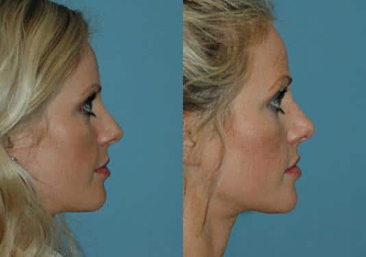 Before and after Rhinoplasty by Dr. Shervin Naderi, Patient 8875