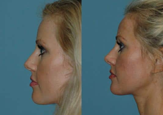 Before and after Rhinoplasty by Dr. Shervin Naderi, Patient 8875