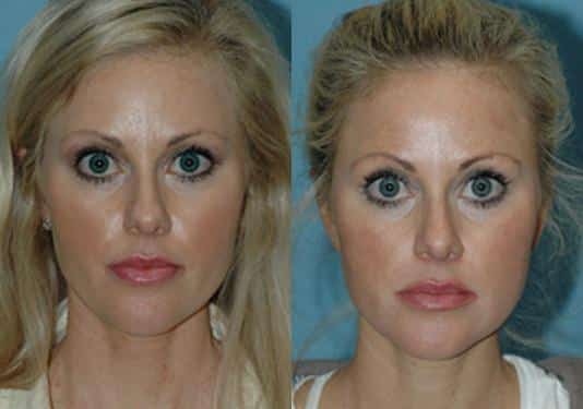 Before and after Rhinoplasty by Dr. Shervin Naderi, Patient 8875