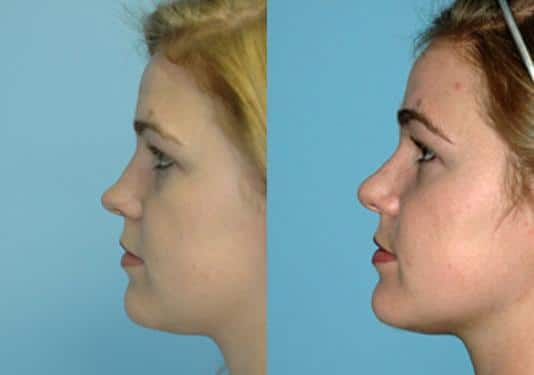 Before and after Rhinoplasty by Dr. Shervin Naderi, Patient 8876