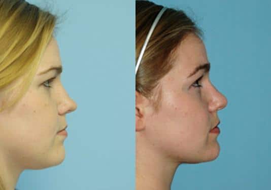 Before and after Rhinoplasty by Dr. Shervin Naderi, Patient 8876