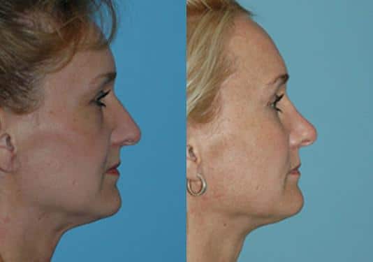 Before and after Rhinoplasty by Dr. Shervin Naderi, Patient 8877