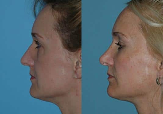 Before and after Rhinoplasty by Dr. Shervin Naderi, Patient 8877