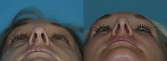 Before and after Rhinoplasty by Dr. Shervin Naderi, Patient 8877