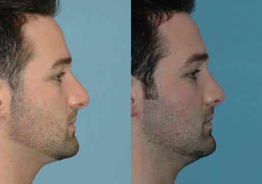 Before and after Rhinoplasty by Dr. Shervin Naderi, Patient 8878