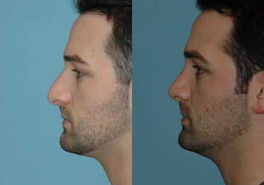 Before and after Rhinoplasty by Dr. Shervin Naderi, Patient 8878