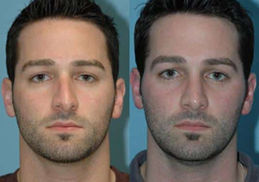 Before and after Rhinoplasty by Dr. Shervin Naderi, Patient 8878