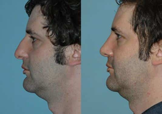 Before and after Rhinoplasty by Dr. Shervin Naderi, Patient 8879