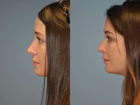 Before and after Rhinoplasty by Dr. Shervin Naderi, Patient 8880