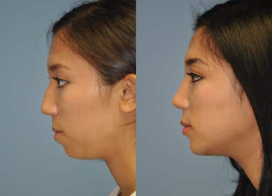 Before and after Rhinoplasty by Dr. Shervin Naderi, Patient 8881