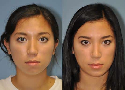 Before and after Rhinoplasty by Dr. Shervin Naderi, Patient 8881