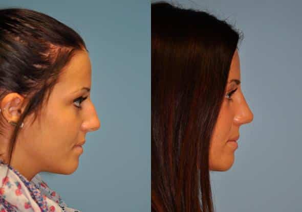 Before and after Rhinoplasty by Dr. Shervin Naderi, Patient 8883