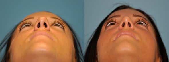 Before and after Rhinoplasty by Dr. Shervin Naderi, Patient 8883