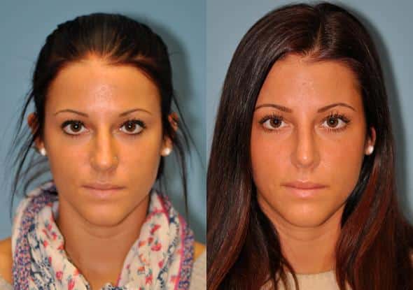 Before and after Rhinoplasty by Dr. Shervin Naderi, Patient 8883