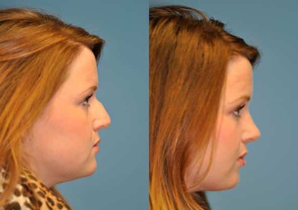 Before and after Rhinoplasty by Dr. Shervin Naderi, Patient 8884