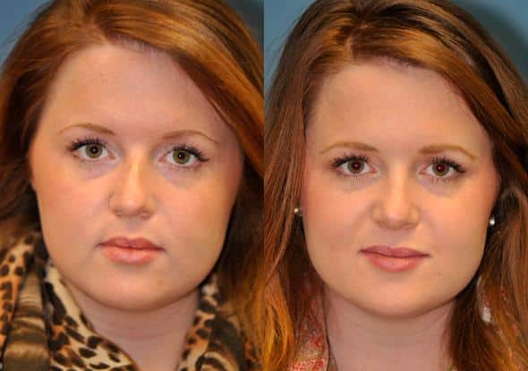 Before and after Rhinoplasty by Dr. Shervin Naderi, Patient 8884