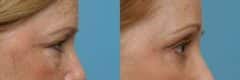 Before and after Blepharoplasty by Dr. Shervin Naderi, Patient 8923