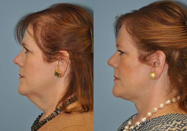 Before and after Facelift by Dr. Shervin Naderi, Patient 8903