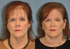 Before and after Facelift by Dr. Shervin Naderi, Patient 8903