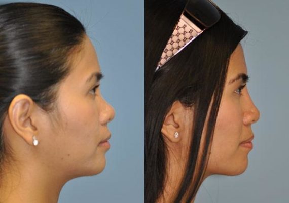 Before and after Non-Surgical Rhinoplasty by Dr. Shervin Naderi, Patient 8914