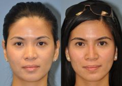 Before and after Non-Surgical Rhinoplasty by Dr. Shervin Naderi, Patient 8914