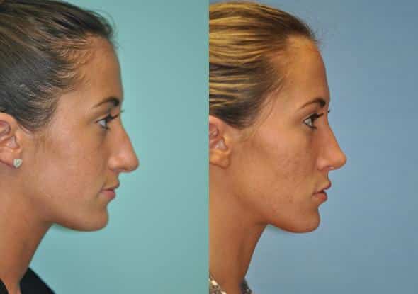 Before and after Rhinoplasty by Dr. Shervin Naderi, Patient 8840