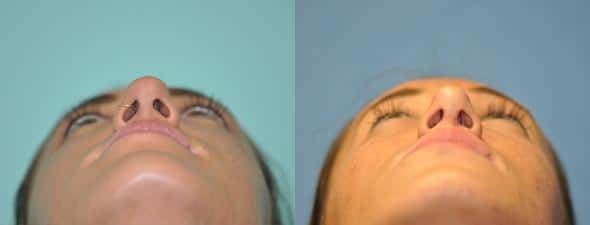 Before and after Rhinoplasty by Dr. Shervin Naderi, Patient 8840