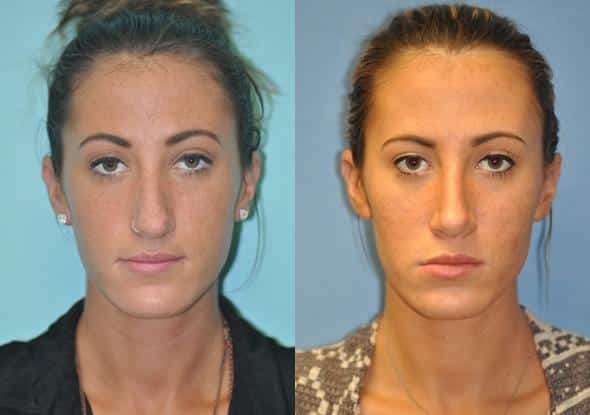 Before and after Rhinoplasty by Dr. Shervin Naderi, Patient 8840