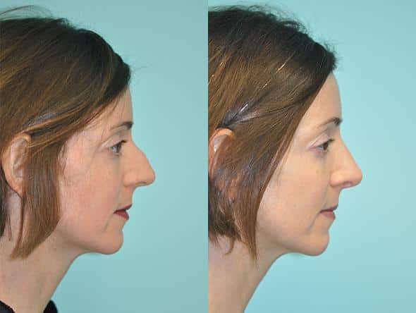 Before and after Rhinoplasty by Dr. Shervin Naderi, Patient 8886