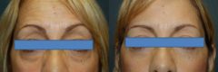 Before and after Blepharoplasty by Dr. Shervin Naderi, Patient 8921