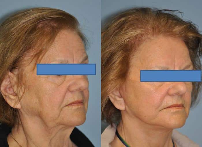 Before and after Facelift by Dr. Shervin Naderi, Patient 8901