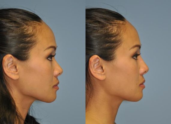 Before and after Non-Surgical Rhinoplasty by Dr. Shervin Naderi, Patient 8916