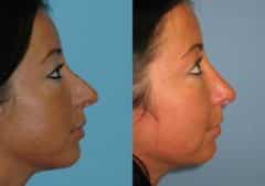 Before and after Revision Rhinoplasty by Dr. Shervin Naderi, Patient 8892