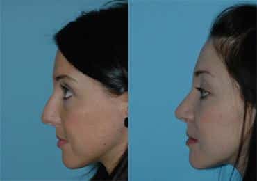 Before and after Rhinoplasty by Dr. Shervin Naderi, Patient 8841