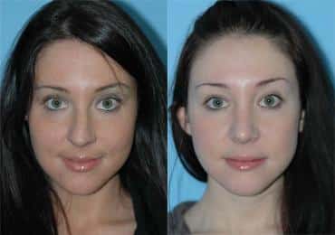 Before and after Rhinoplasty by Dr. Shervin Naderi, Patient 8841