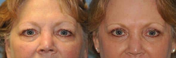 Before and after Blepharoplasty by Dr. Shervin Naderi, Patient 8922