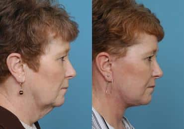 Before and after Facelift by Dr. Shervin Naderi, Patient 8904