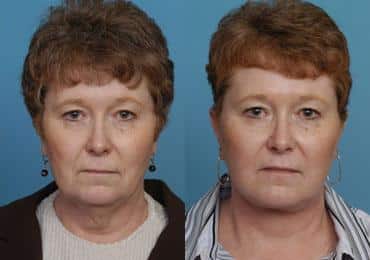 Before and after Facelift by Dr. Shervin Naderi, Patient 8904