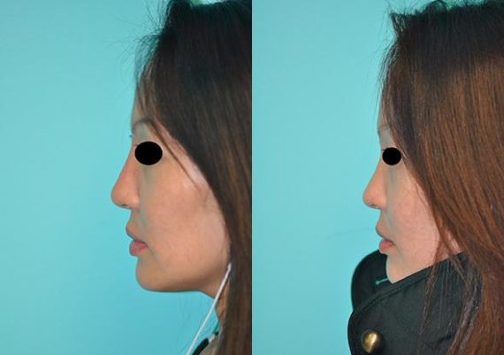 Before and after Non-Surgical Rhinoplasty by Dr. Shervin Naderi, Patient 8917