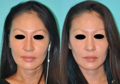 Before and after Non-Surgical Rhinoplasty by Dr. Shervin Naderi, Patient 8917