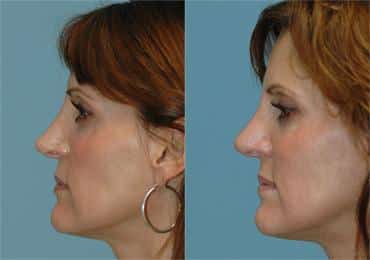 Before and after Revision Rhinoplasty by Dr. Shervin Naderi, Patient 8893