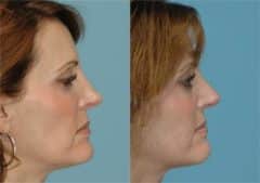 Before and after Revision Rhinoplasty by Dr. Shervin Naderi, Patient 8893