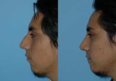 Before and after Rhinoplasty by Dr. Shervin Naderi, Patient 8842