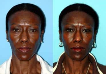 Before and after Blepharoplasty by Dr. Shervin Naderi, Patient 8924