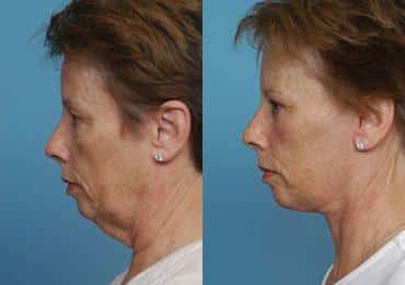 Before and after Facelift by Dr. Shervin Naderi, Patient 8905