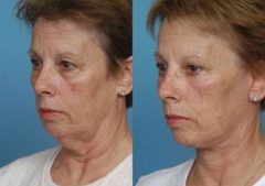 Before and after Facelift by Dr. Shervin Naderi, Patient 8905