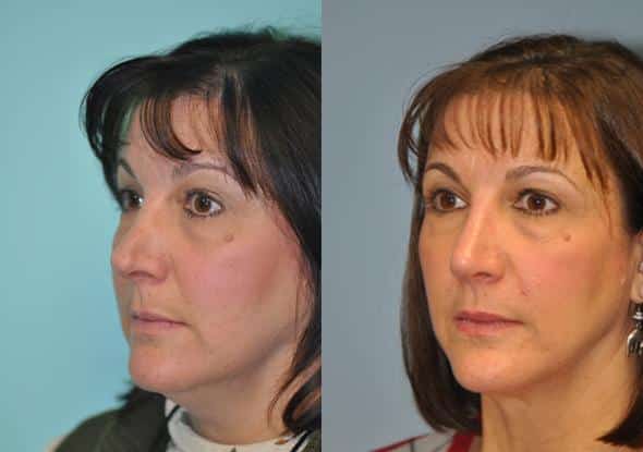 Before and after Revision Rhinoplasty by Dr. Shervin Naderi, Patient 8894