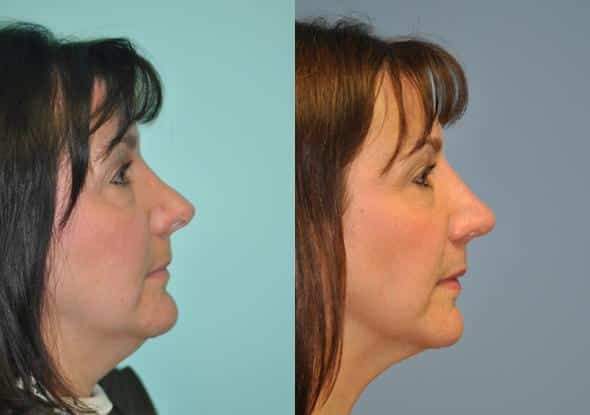 Before and after Revision Rhinoplasty by Dr. Shervin Naderi, Patient 8894