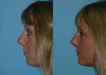 Before and after Rhinoplasty by Dr. Shervin Naderi, Patient 8843