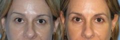 Before and after Blepharoplasty by Dr. Shervin Naderi, Patient 8925